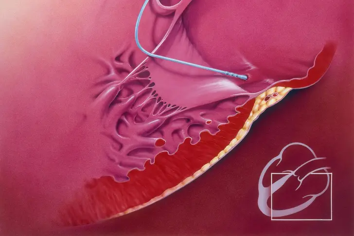 What Is an Ablation?