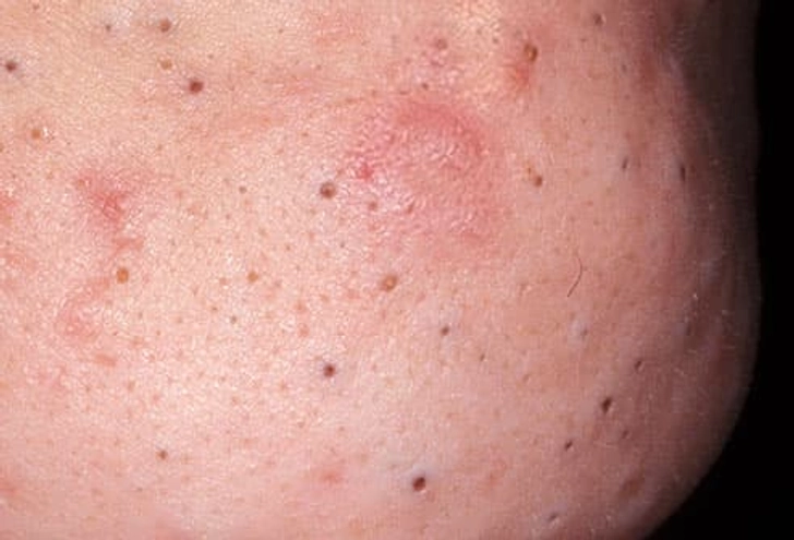 Blackheads Blackheads