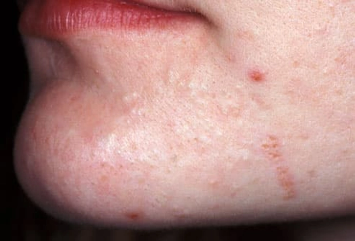 Mild Acne Mild Acne