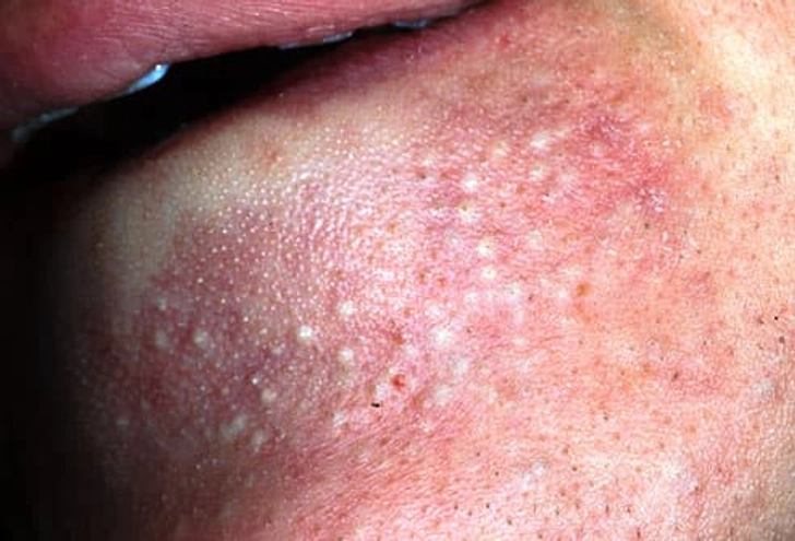 Papules Papules