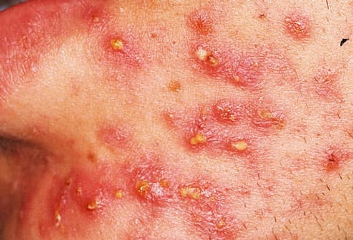 Pustules Pustules