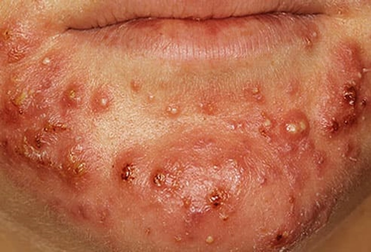 Severe Nodulocystic Acne