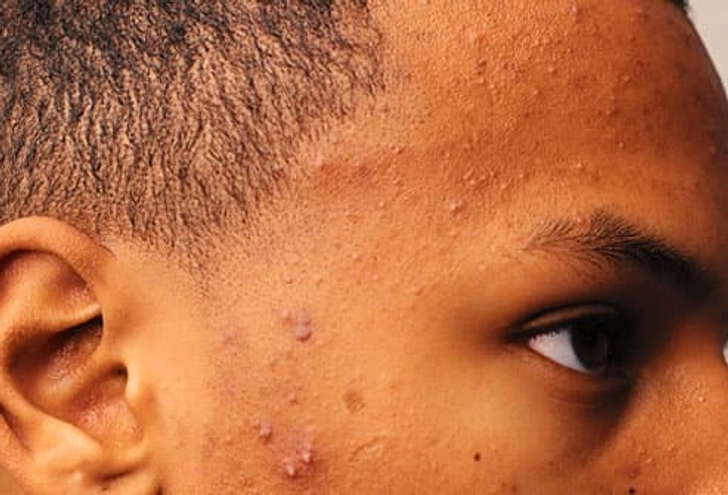 Moderate Acne
