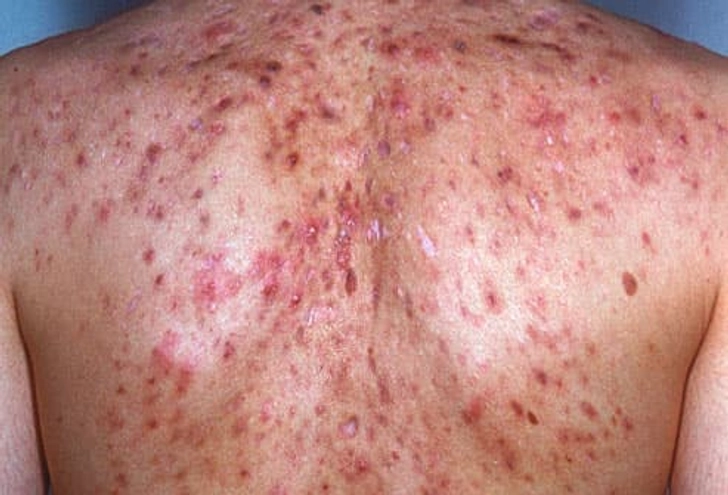 Acne Conglobata Acne Conglobata
