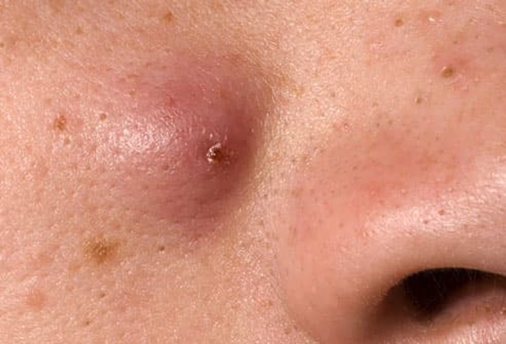 Nodules Nodules