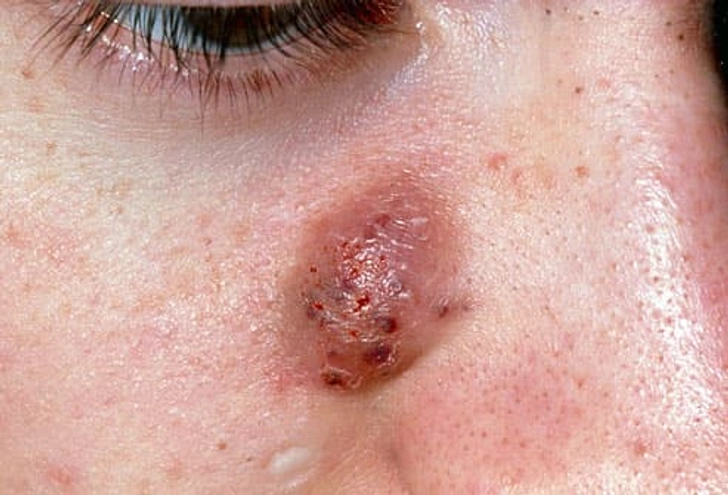 Cysts Cysts
