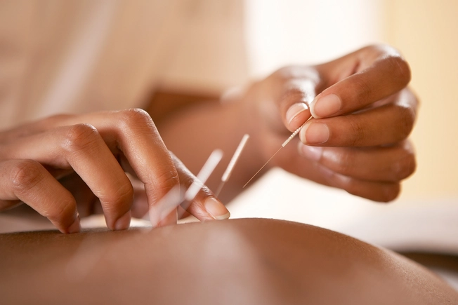 Acupuncture Acupuncture