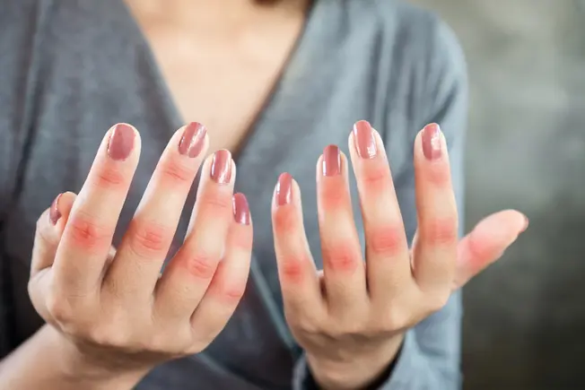 Mental Health Exercises to Manage Stress and Other Lupus Triggers Mental Health Exercises to Manage Stress and Other Lupus Triggers