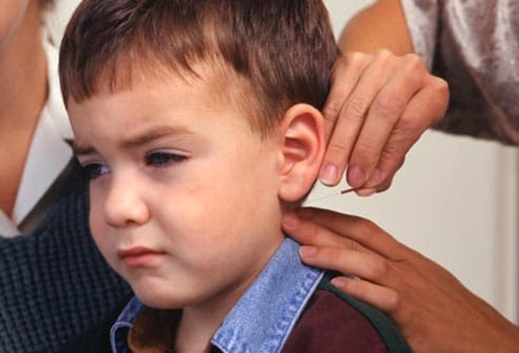 Acupuncture and Children Acupuncture and Children