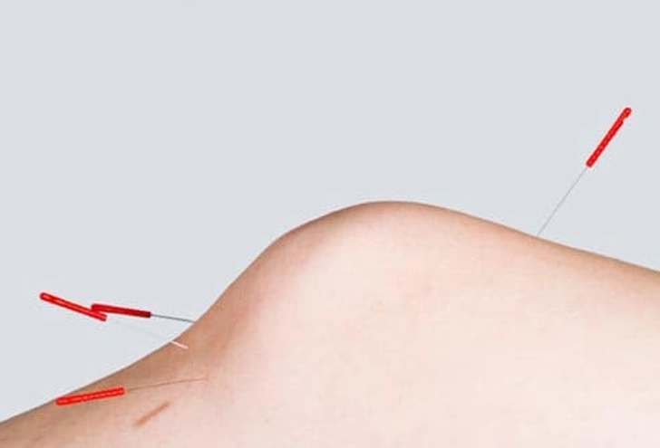 Acupoint: Arthritis Pain