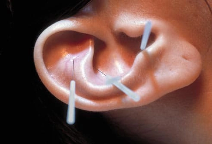 Acupuncture to Quit Smoking?