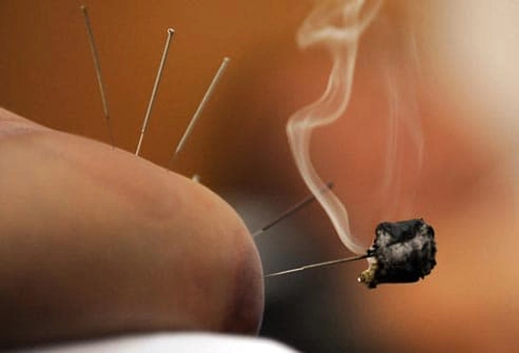 Acupuncture Variations