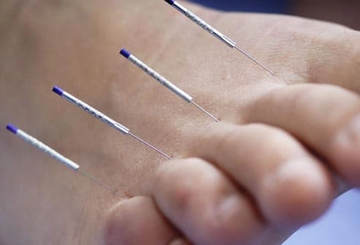 Acupoint: Other Pain Acupoint: Other Pain