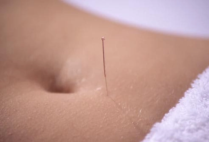 Acupuncture and Fertility Acupuncture and Fertility