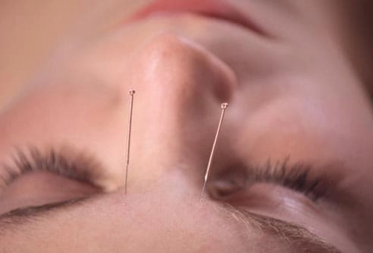 Acupoint: Headaches
