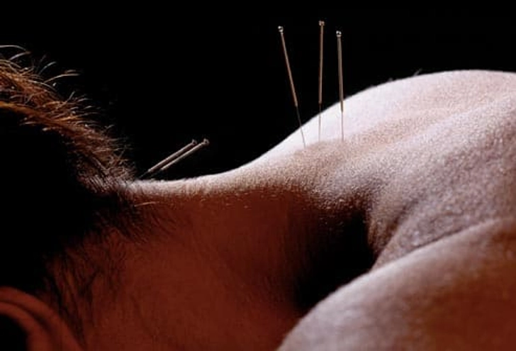 Acupoint: Fibromyalgia