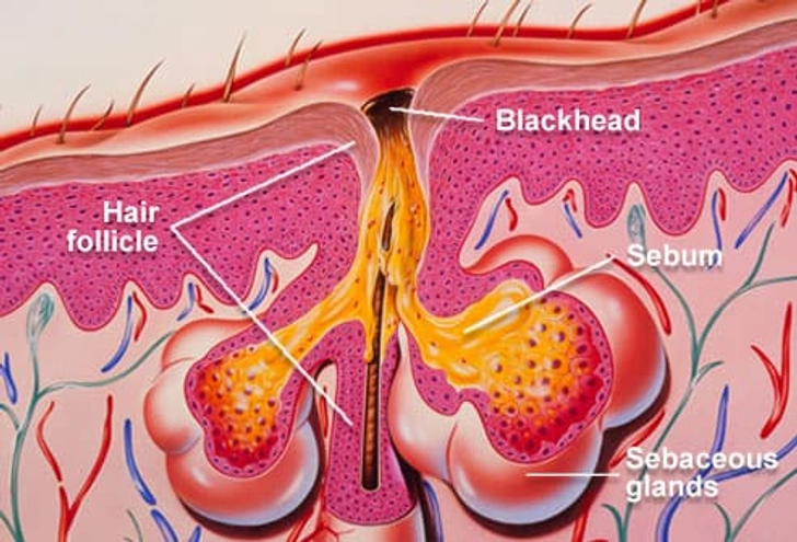 I wash a lot but still get blackheads. Why?