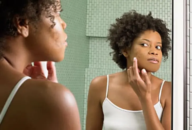 Why do I still have acne in my late 20s?