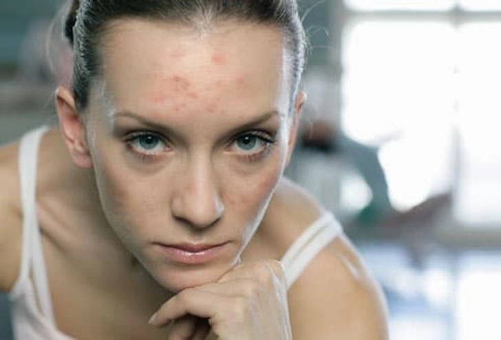 Could my acne be related to anemia?
