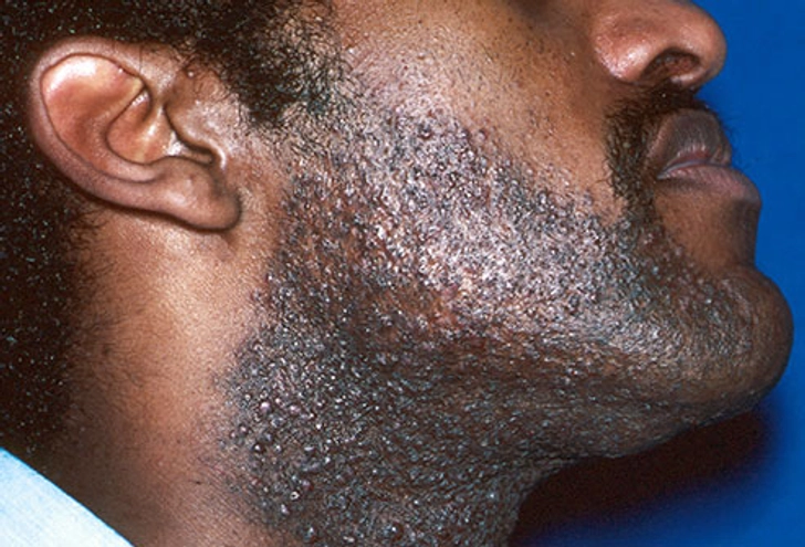 Razor Bumps Razor Bumps