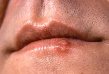 Cold sores, or fever blisters, are groups of small blisters on the lip and around the mouth. The skin around the blisters is often red, swollen, and sore. Photo credit: Courtesy of the CDC