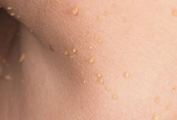 Skin Tags Skin Tags