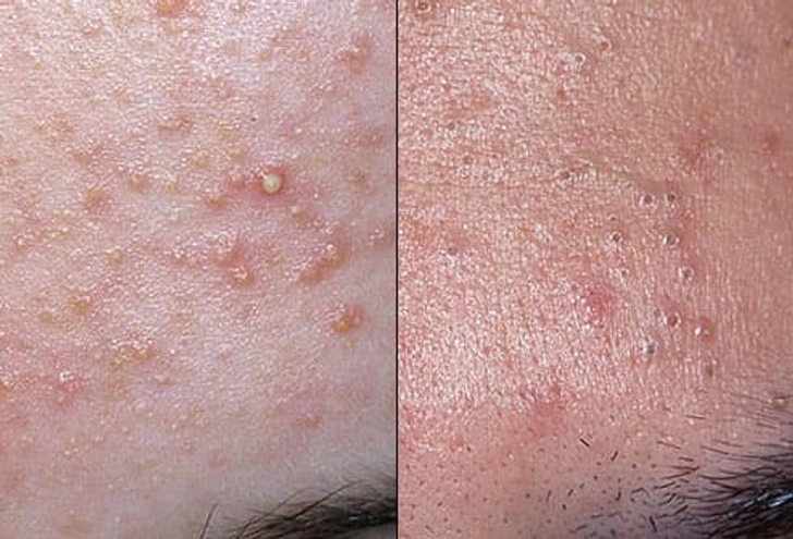 Acne Acne