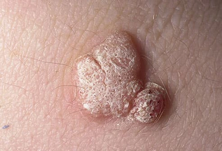 Warts Warts