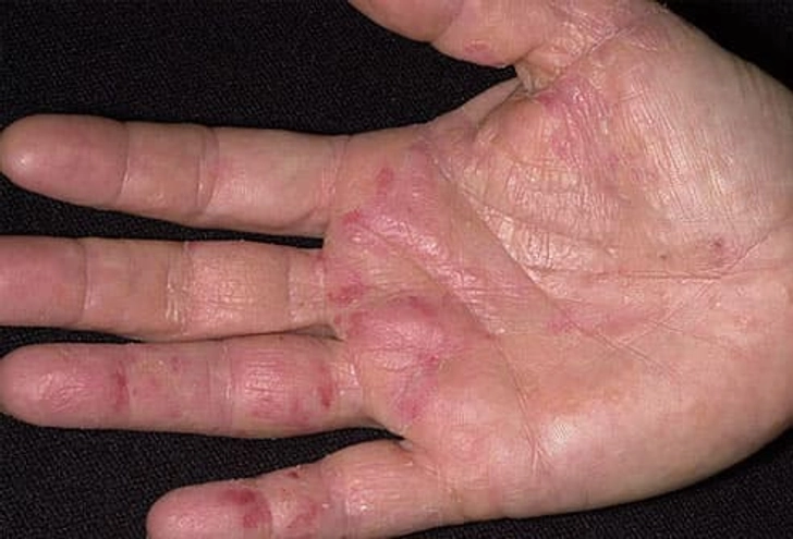 Eczema Eczema