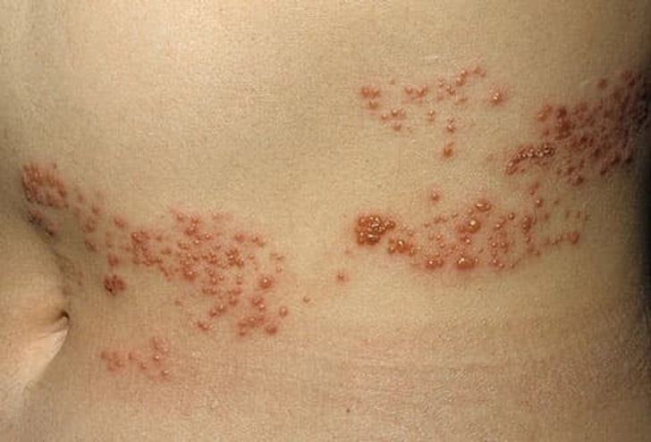Shingles (Herpes Zoster) Shingles (Herpes Zoster)