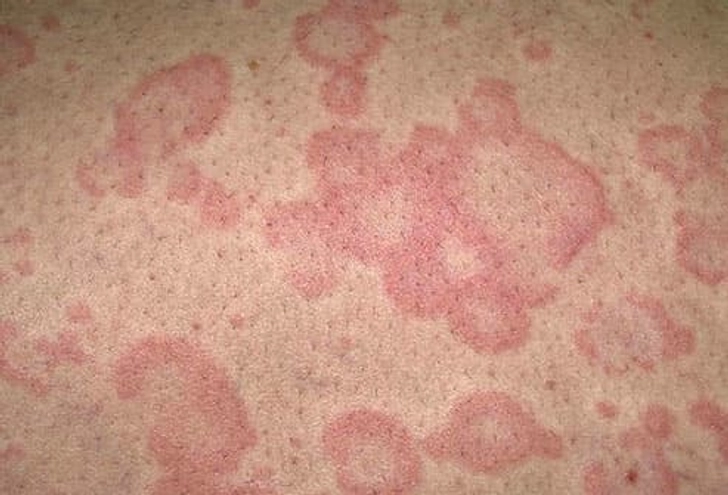 Hives (Urticaria) Hives (Urticaria)