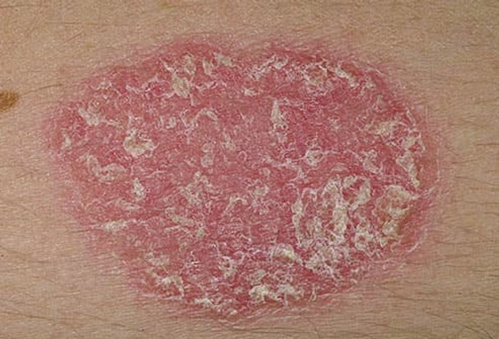 Psoriasis Psoriasis