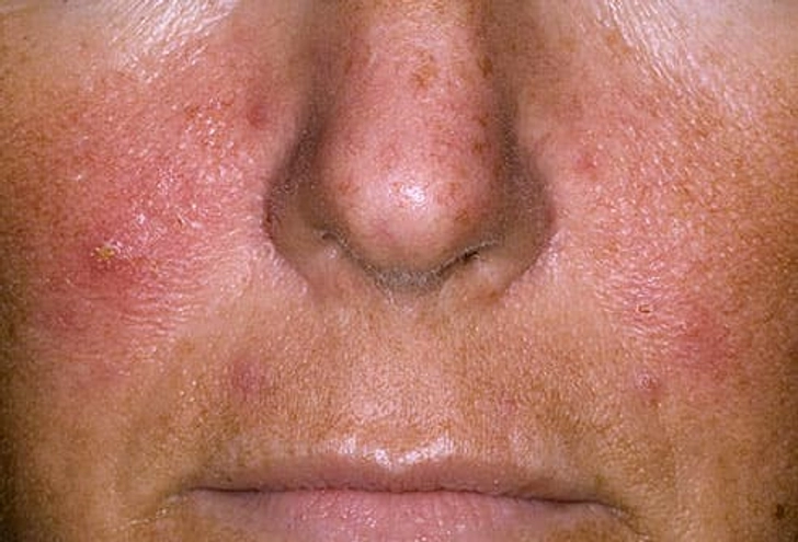 Rosacea Rosacea