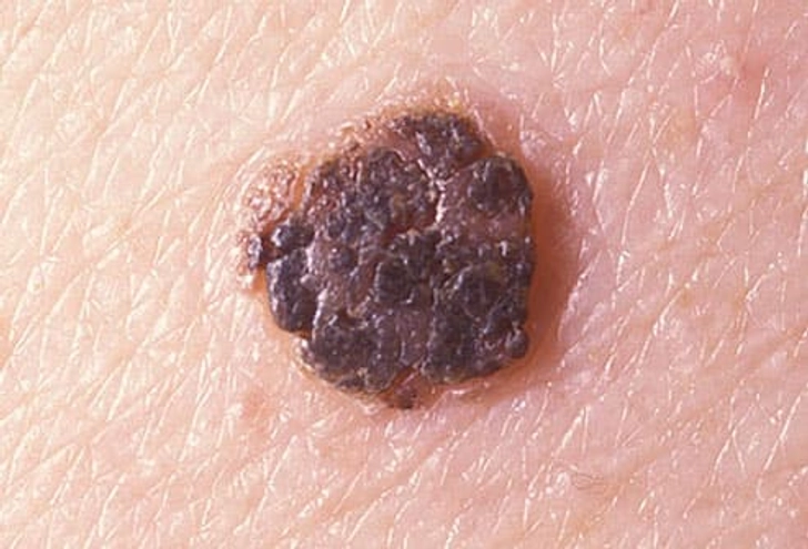 Seborrheic Keratoses Seborrheic Keratoses
