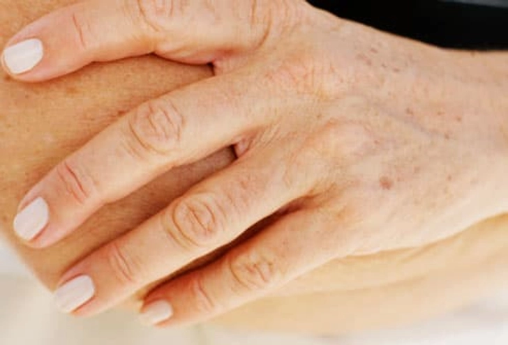 Age or Liver Spots Age or Liver Spots