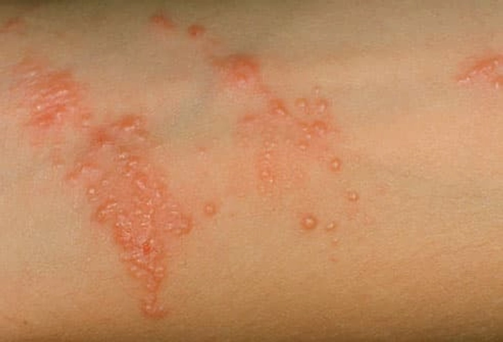 Rash From Plants Rash From Plants