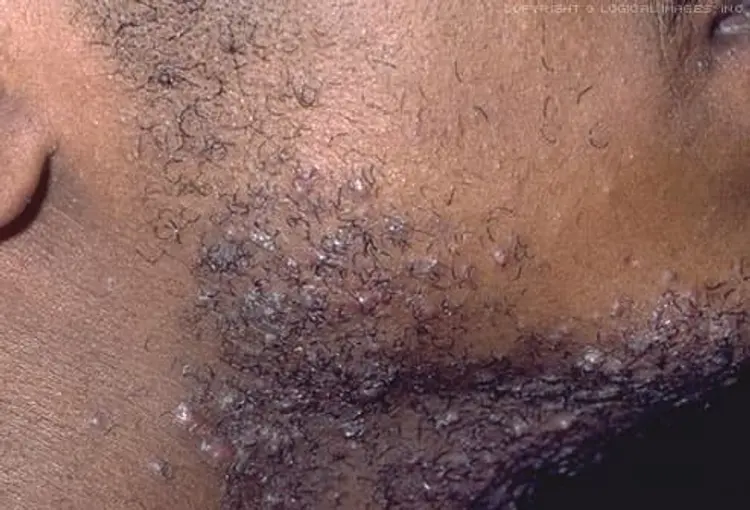 Photo of razor bumps on jaw and neck