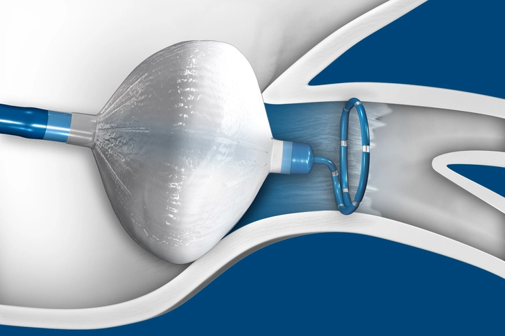 Cryoballoon Ablation