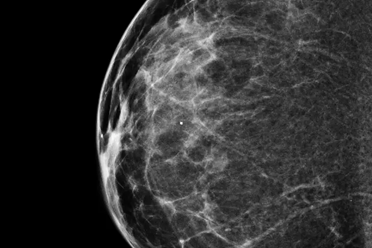 3D Mammograms