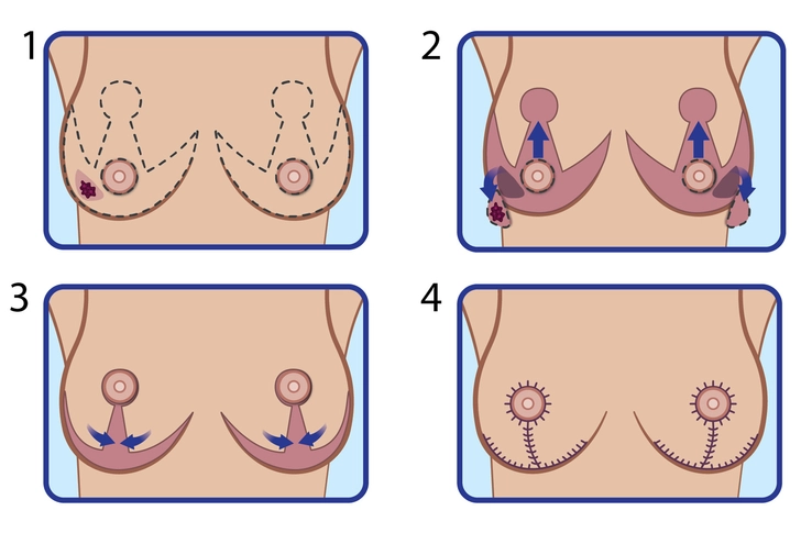 Oncoplastic Surgery Oncoplastic Surgery