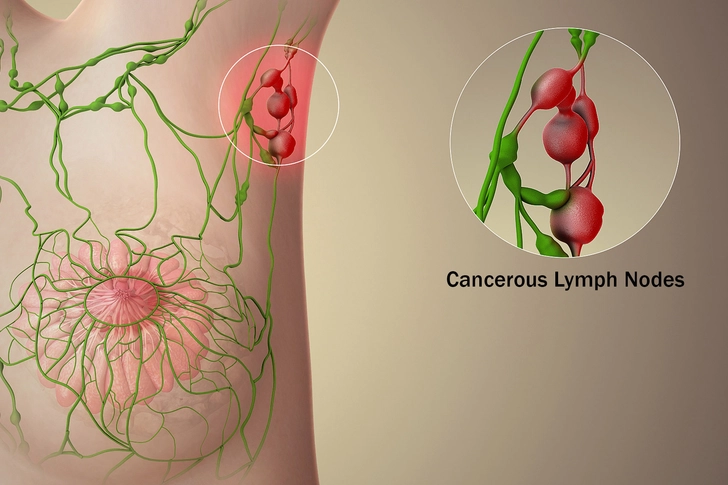 Sentinel Lymph Node Mapping