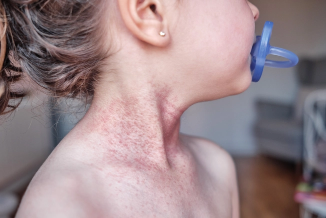 Biologic Update: Dupixent
