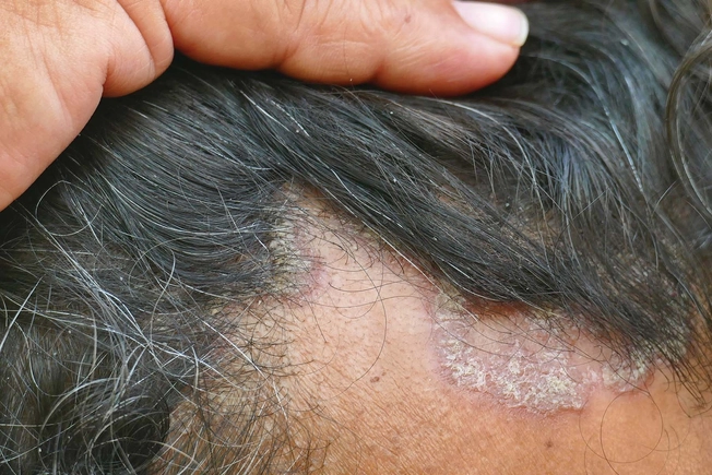 In Clinical Trials: PDE4 Inhibitor Foam