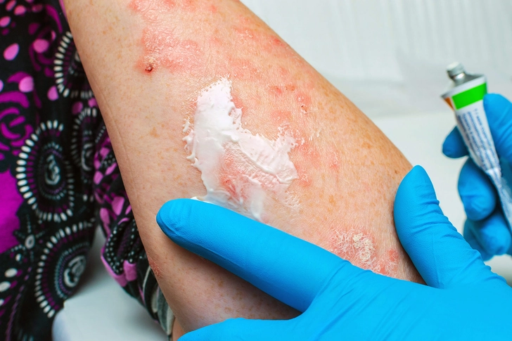 New Type of Topical Approved 