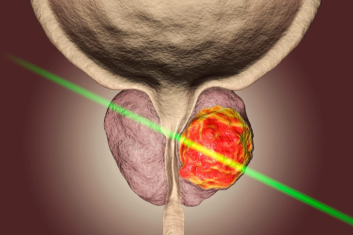 Focal Laser Ablation