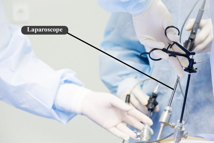 Laparoscopic or Robotic Myomectomy Laparoscopic or Robotic Myomectomy