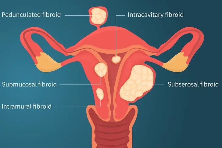 Uterine Fibroid Treatment: Know Your Choices Uterine Fibroid Treatment: Know Your Choices