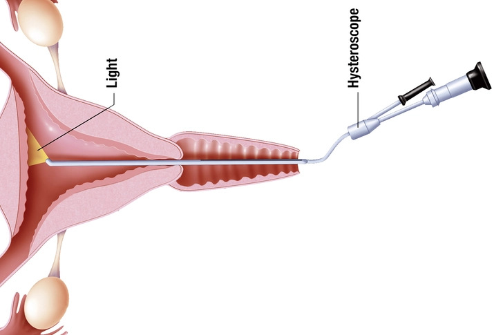Hysteroscopic Myomectomy 