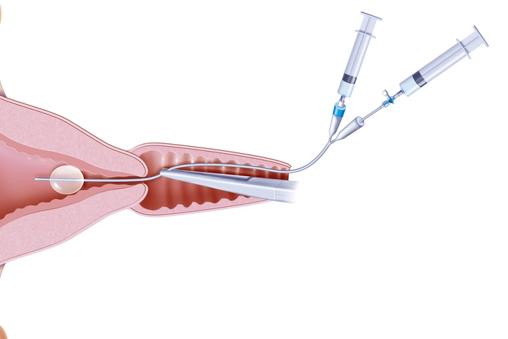 Endometrial Ablation 