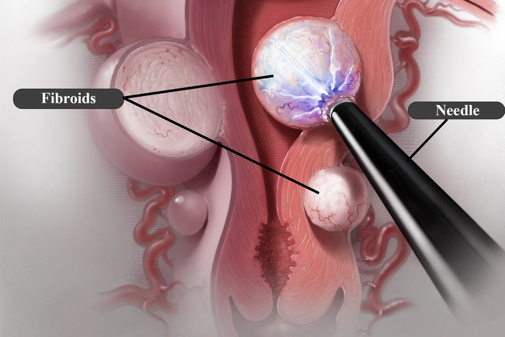 Radiofrequency Ablation (RFA) Radiofrequency Ablation (RFA)